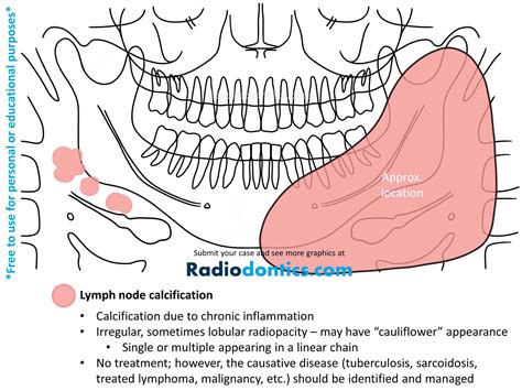 Calcification Of Lymph Nodes