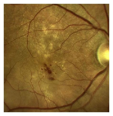 Multimodal Retinal Imaging Of Retinal Angiomatous Proliferation Rap