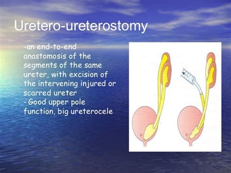 Ureterocele