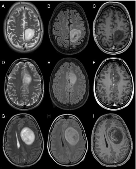 Adult Type Gliomas Astrocytoma Idh Mutant Mri Of Three Different