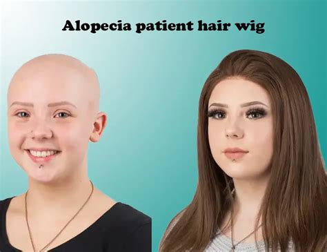 Alopecia Patients Hair Wigs Supplier In Noida Ms Hair Fixing Clinic