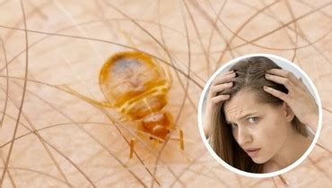 rid  bed bugs   hair expert guidelines townhustle