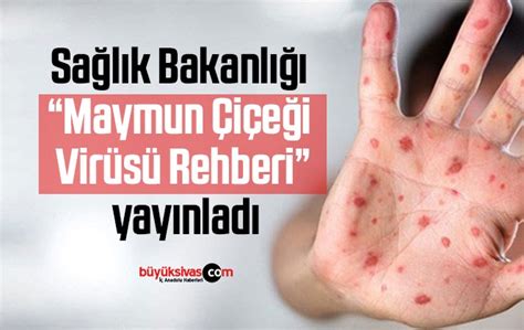 Sağlık Bakanlığı Maymun Çiçeği Virüsü Rehberi yayınladıBüyük Sivas