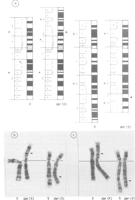 A Diagram Of The Normal And Abnormal Chromosomes X And 5 B And C Download Scientific