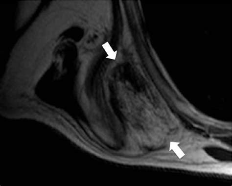 Scapula Bursitis