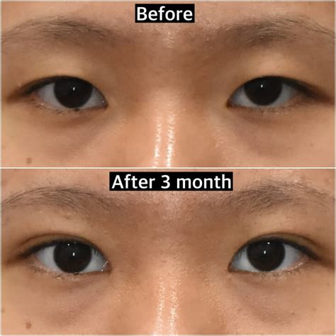 Comparing Surgical Method In Double Eyelid Surgery Korea Noonopi Plastic Surgery Blog