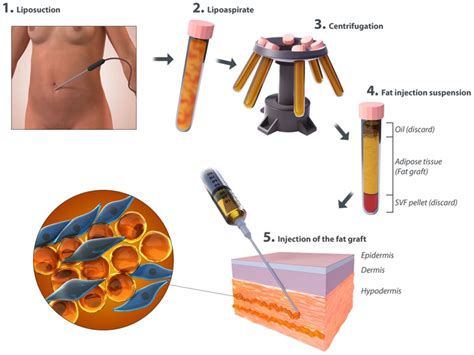 Autologous Fat Transfer Process Image By Info Clinicalillustration