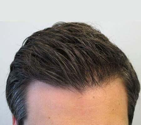 Mens Hair Loss Treatment Dr Health Clinic Homepage