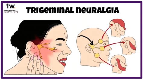 All You Should Know About Trigeminal Neuralgia YouTube