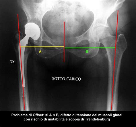 Protesi Totale Di Anca Studio Ortopedico Pytheas