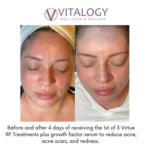 Skin Tightening New Virtue Rf Microneedling Homewood Al