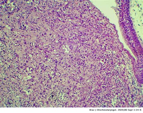 Undifferentiated High Grade Pleomorphic Sarcoma Of The Larynx Treated