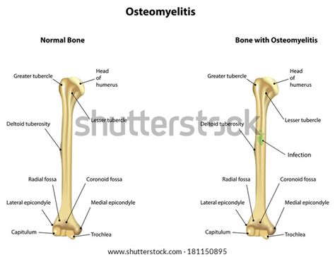 Humerus Diagram