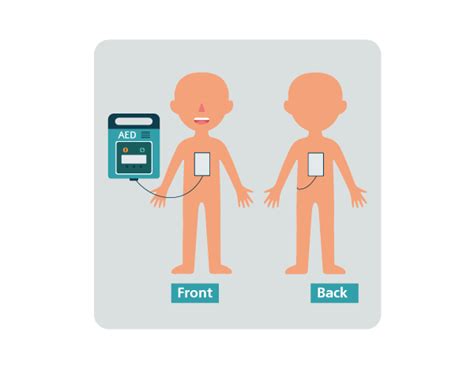 Automated External Defibrillator Pad Placement