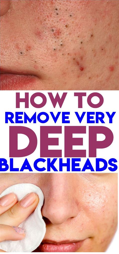 How To Get Rid Of Deep Blackheads Healthy And News