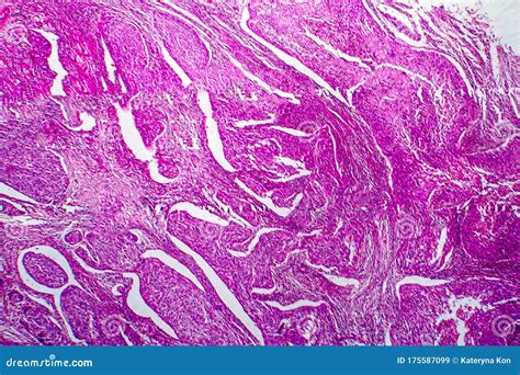 Carcinoma De C Lulas Escamosas De La Micrograf A De La Luz Del Tero