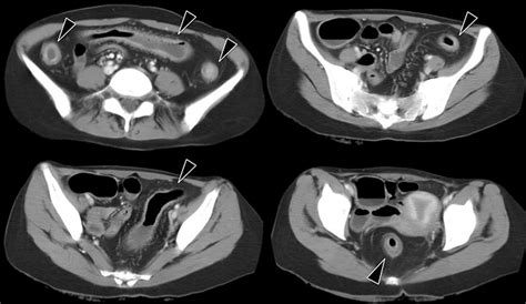 Figure1 Contrast Enhanced Abdominal Ct Images At Admission The Images Download Scientific