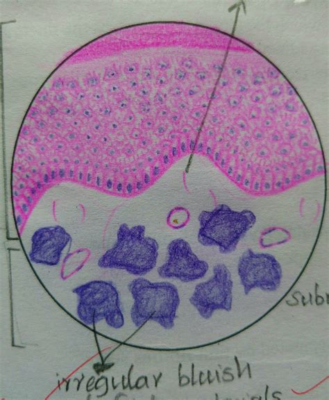 Histopathology Drawings: Calcinosis cutis
