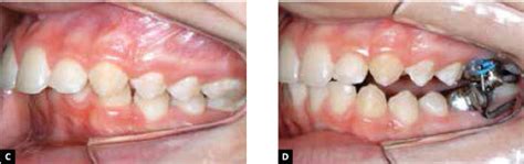 Scielo Brasil Angle Class Ii Correction With Mara Appliance Angle Class Ii Correction With