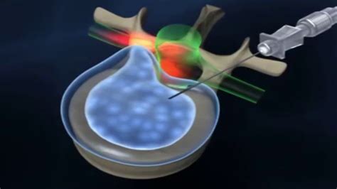 Descompress O Lombar Por Sistema Minimamente Invasivo Percut Neo