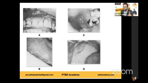 Case Based Discussions Ibd Crohn S Disease Cobblestone Appearance Learning Is Fun Youtube