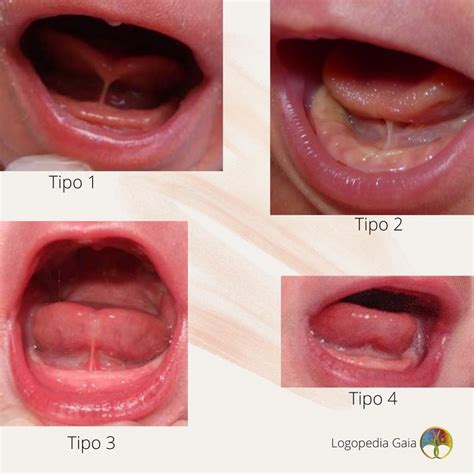 Frenillo Lingual Corto O Anquiloglosia Centro Psicolog A Y Logopedia Gaia