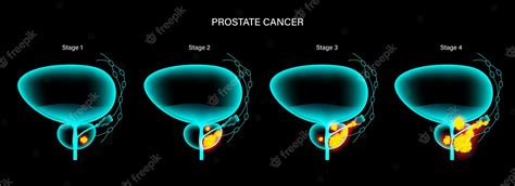 Premium Vector Prostate Cancer Concept