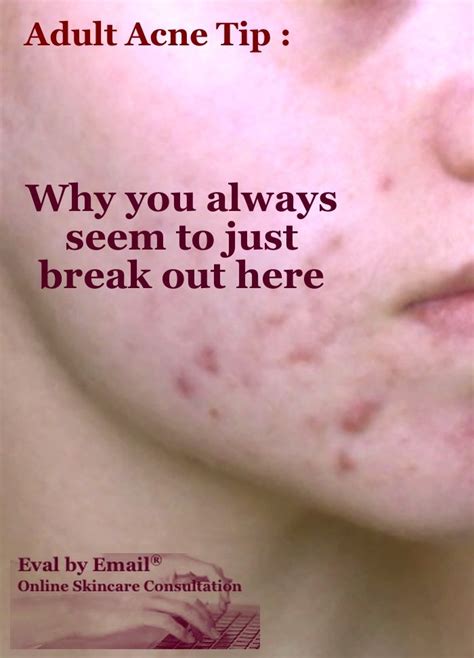 Adult Acne Tip Often Breakouts Along The Sides Of The Chin And Jaw Are Described As