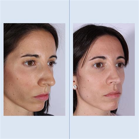 Rinoplastia Ultrasónica Clínica Planas Barcelona