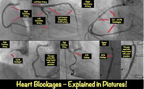 Heart On Right Side Percentage - Photos Idea