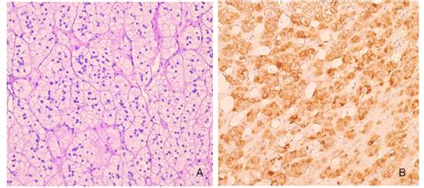 Histopathological Features Of Adrenocortical Adenoma Of The Adrenal Download Scientific Diagram