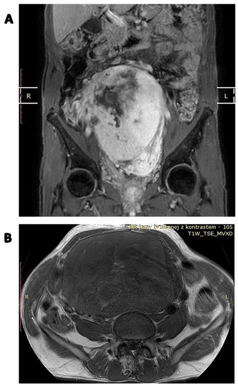 Cancers Free Full Text Diagnostics And Treatment Of Extrameningeal