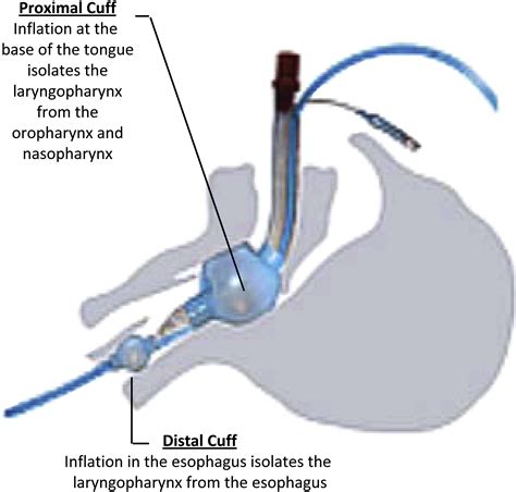 Airway Devices