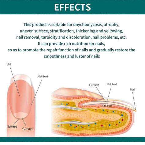 Nailner Brush Against Nail Fungal Infection 2 in1 treat & brighten