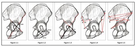 Diagrams Illustrating Pelvic Morphometric Landmarks And Dimensional