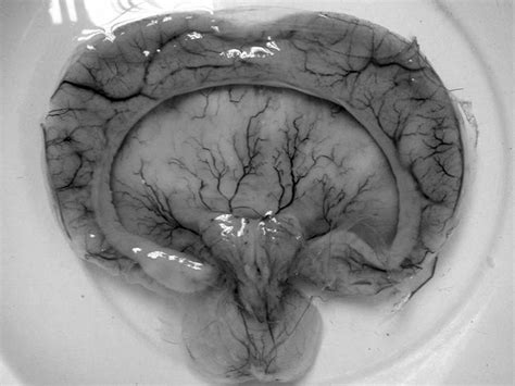 Cyclopia: Causes, diagnosis, and life expectancy