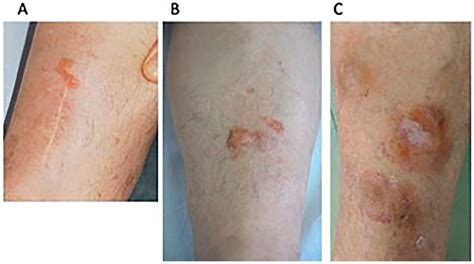 Dermatopathology Free Full Text Primary Localized Cutaneous Nodular