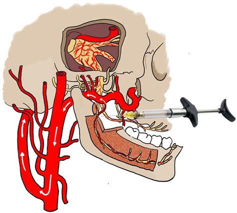 A Stroke Mimicker Following Inferior Alveolar Nerve Block A Case