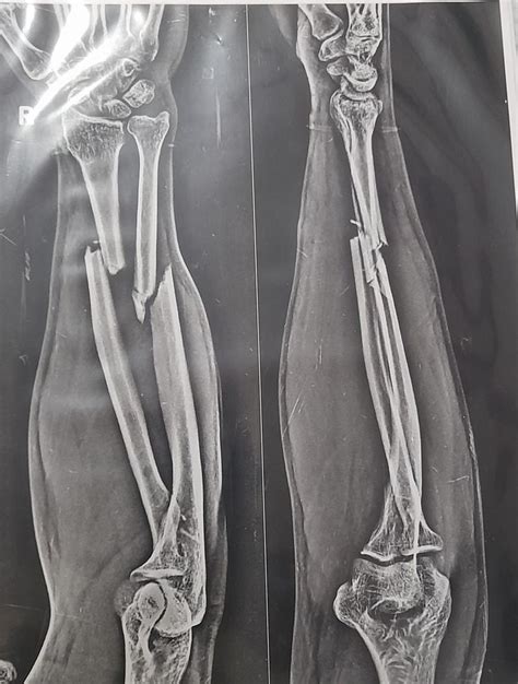 Fracture of radius and ulna shaft. | Radius and ulna, Upper limb anatomy, X ray