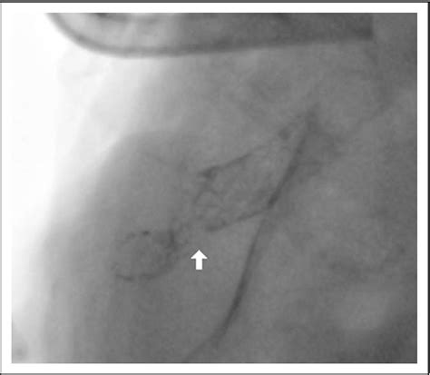 Figure 3 From Hybrid Perventricular Pulmonary Valve Perforation And