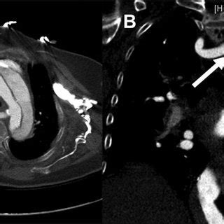 Preoperative Computed Tomography Scan In Axial A And Coronal B