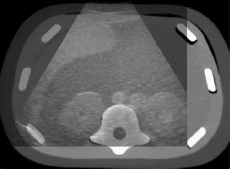 Real Time Ultrasound Image Overlaid With Corresponding Multiplanar