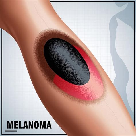 Managing Melanoma Causes Symptoms And Treatment Premium Ai Generated