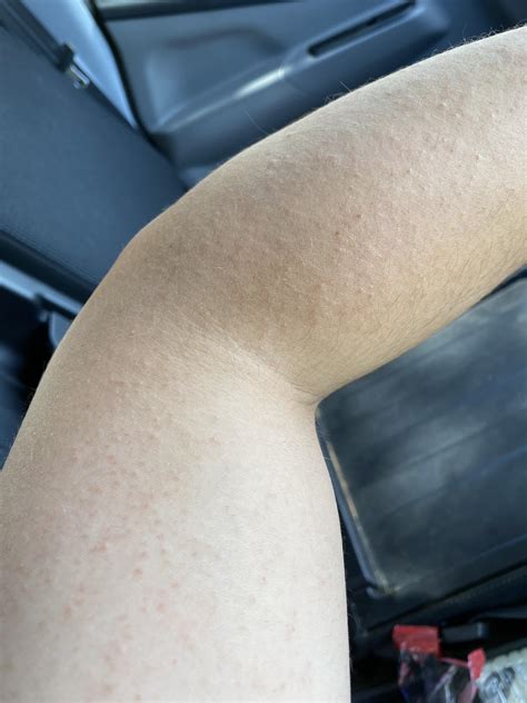 Itchy Skin Bumps On Arms