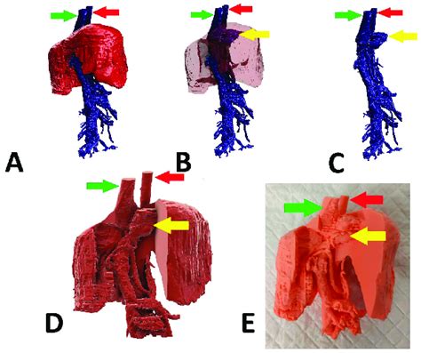 Preoperative stages of the shunt visualization of patient no 2: (A ...