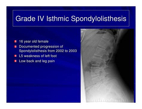 Case Review #1: 16 year old with Isthmic Spondylolisthesis Grade IV