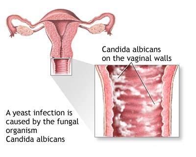 Yeast Infections | Yeast Infection Home Remedy