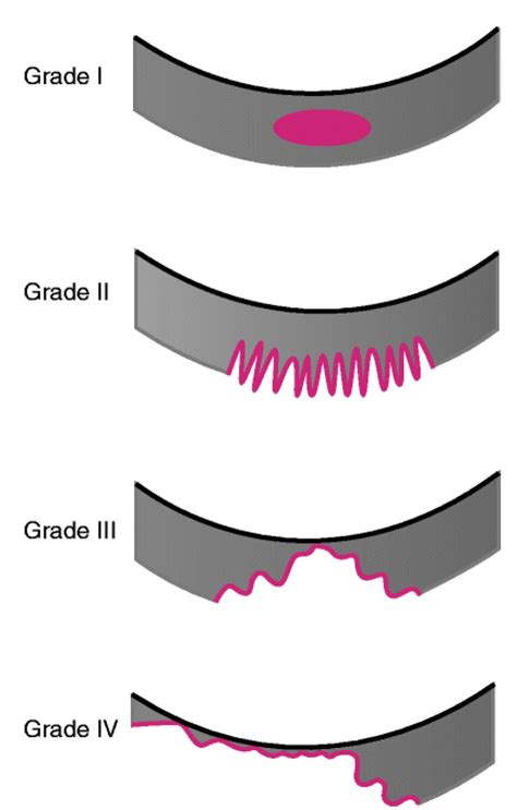 4 Stages Of Osteoarthritis 321gomd