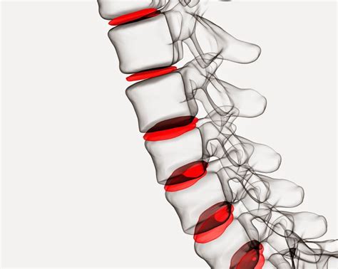 MMAR Medical: What to Expect After Herniated Disc Surgery