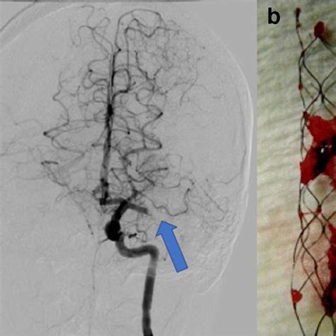 A Cerebral Angiogram From A Young Patient With An Acute Ischemic Stroke